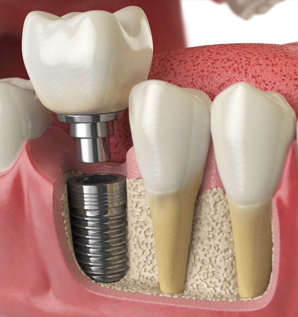 Dental Implant Pricing