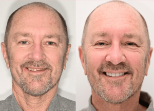 before and after dental implants