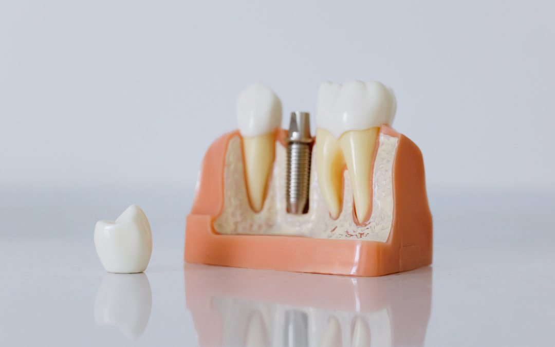 Dental Implants for Missing Teeth: Get Your Smile Back!