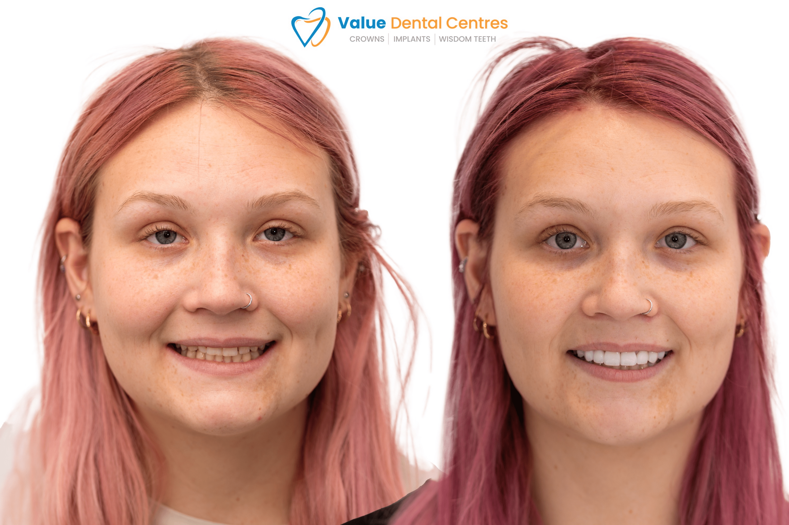 Young-Clients-Crowns