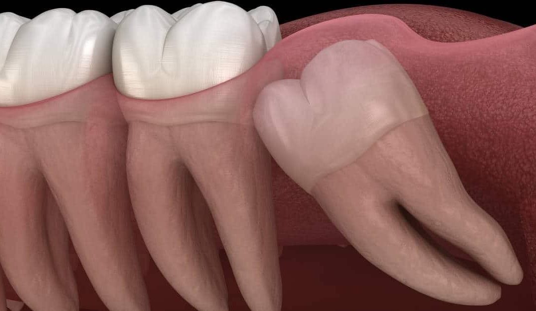 Making the Call – When to Get Wisdom Teeth Removed