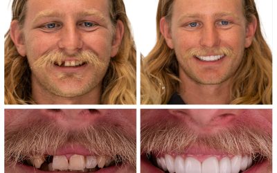 A Step-by-Step Look at What’s Involved in a Smile Makeover