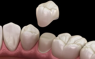 Understanding the Process of Fitting a Dental Crown