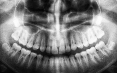 The Wisdom Behind Wisdom Teeth and Why We Have Them