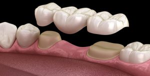 dental bridges