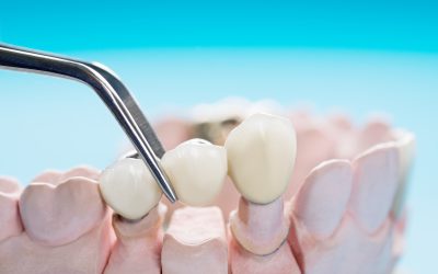 Complete Your Smile with Value Dental Centres’ Dental Bridges