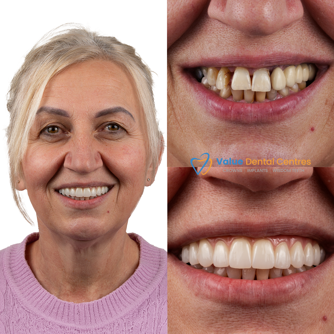 brfore & after Teeth reconstruction