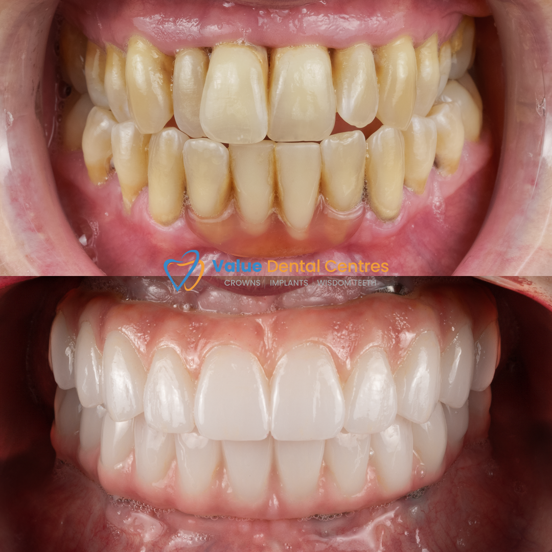 tooth replacement options