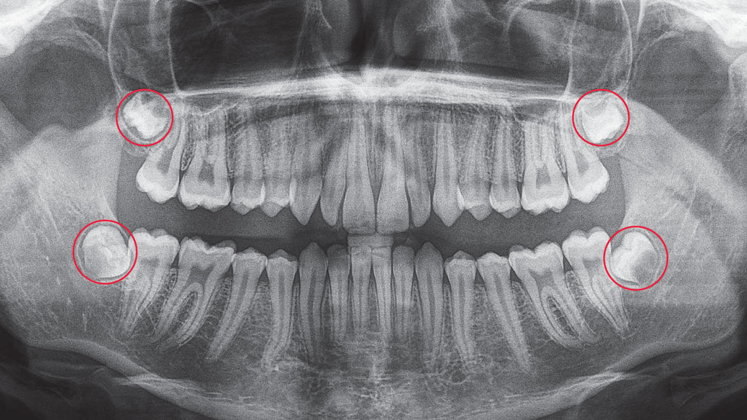 Wisdom teeth Extraction Brisbane